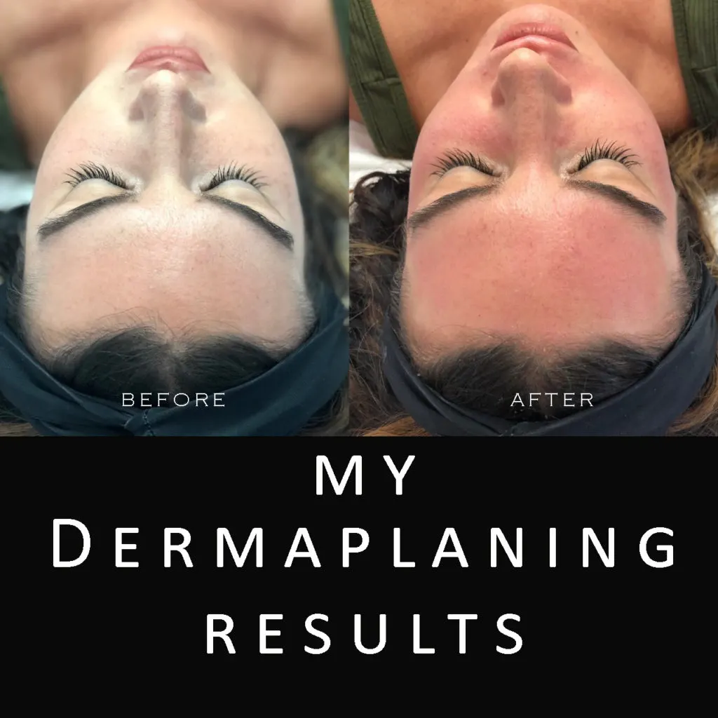 my dermaplaning results
