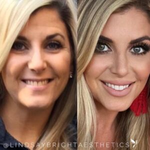 My Favorite Non-Surgical Procedure for Facial Contouring - RHA ...